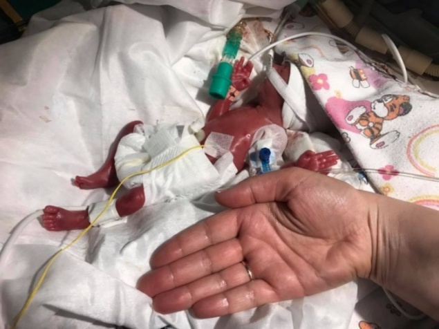 500-граммовая малышка размером с ладонь пошла на поправку и прибавила в весе