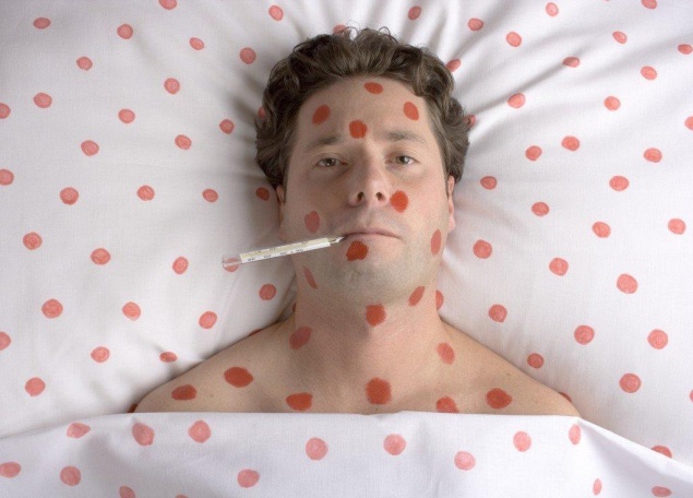 Детская ветрянка: в чем опасность для взрослых