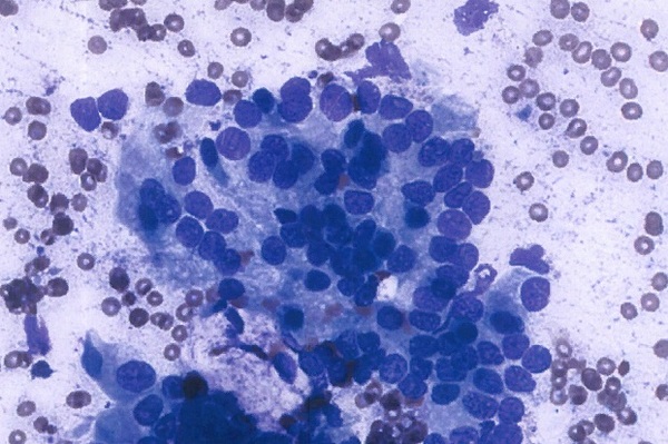 Ученые успешно протестировали новую терапию для лечения рака поджелудочной железы