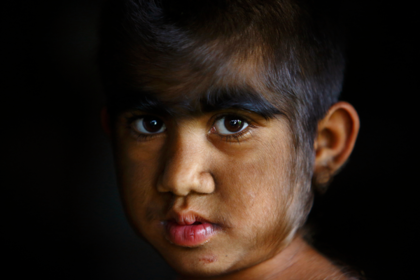 Редкое заболевание сделало детей похожими на оборотней