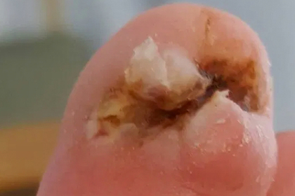 Женщина решила пробежать пять километров и лишилась ноги