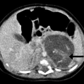 Новорожденная гонконгская девочка оказалась беременной двумя братьями
