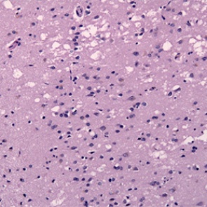 Впервые выявлены случаи заражения болезнью Альцгеймера