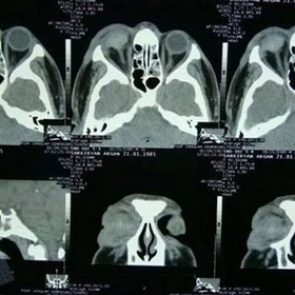 Охранники бара на Бали выбили глаз российскому туристу