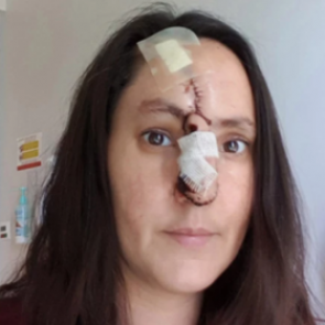 Женщина принимала рак за царапину и лишилась носа