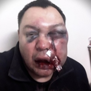 Российского депутата избили железной трубой